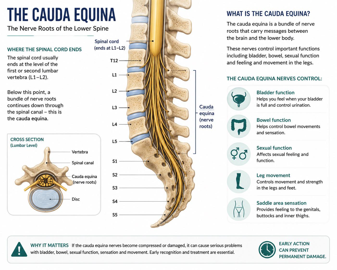 Infographic showing the cauda equina — the bundle of nerve roots at the base of the spinal cord — and the bladder, bowel, sexual, leg and saddle-area functions it controls